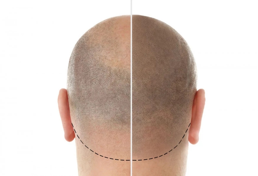 5 Days Istanbul City Tour and Hair Transplant Program 3