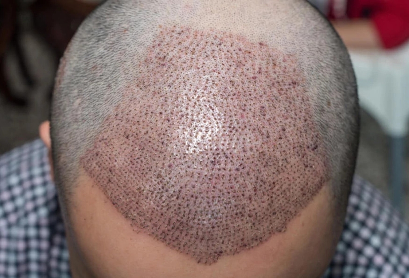 5 Days Istanbul City Tour and Hair Transplant Program 4