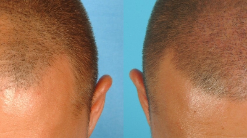 3 Days Istanbul City Tour and Hair Transplant Package 4