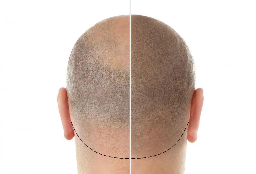 5 Days Istanbul City Tour and Hair Transplant Program