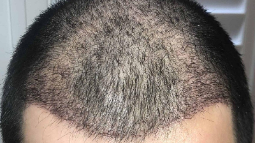 3 Days Istanbul City Tour and Hair Transplant Package 2